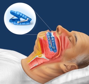 sleep apnea oral appliance